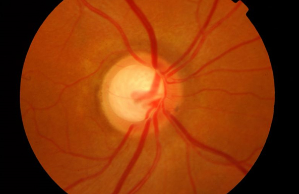 optic-nerve-head-in-glaucoma